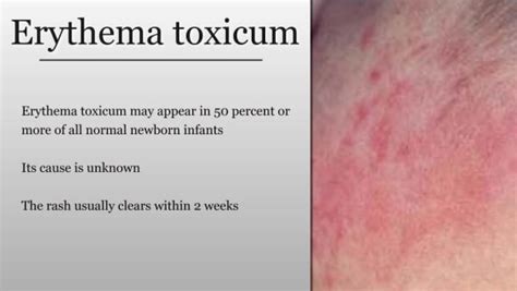 Erythema Toxicum In Newborns
