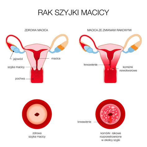 Profilaktyka Raka Szyjki Macicy Wczesne Wykrywanie Raka Szyjki Macicy Hpv Bezp Atna