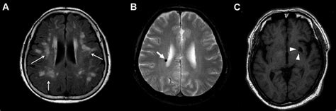 Representative Brain Mri Of Cerebral Small Vessel Disease In Patients