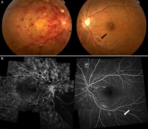 A Case Of Central Retinal Vein Occlusion Crvo In The Right Eye