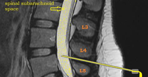 El Baúl Radiológico Complicaciones De La PunciÓn Lumbar Complications
