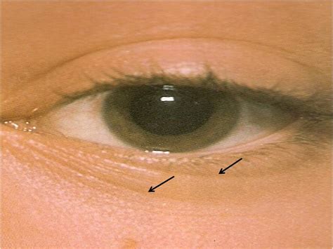 Sinal De Dennie Morgan