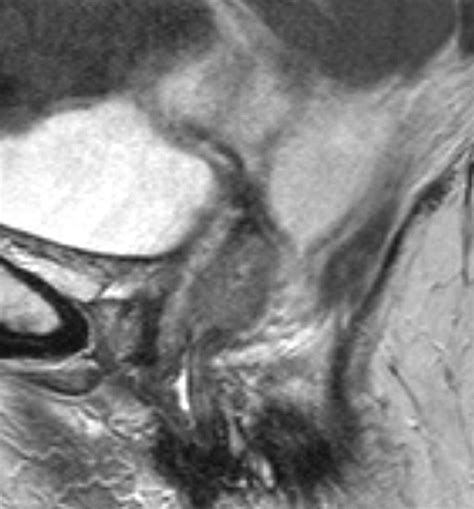 Mr Imaging Features Of Vaginal Malignancies Radiographics