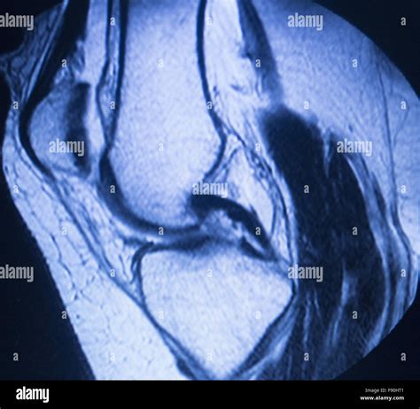 Mri Magnetic Resonance Imaging Medical Scan Test Results Showing Knee