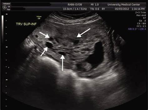 Gestational Trophoblastic Neoplasia Obstetrics And Gynecology 7 Ed