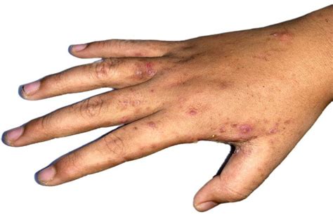 What Is Scabies Nabtahealth Womens Health And Wellness