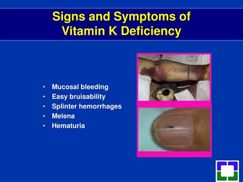 Ppt Fat Soluble Vitamin Deficiencies Powerpoint Presentation Free