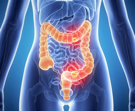 Colon Cancer Breakthrough Could Lead To Prevention The Foods That Can