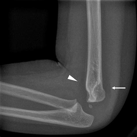 Elbow Effusion Utility And Limitations Of Radiography In Pediatric