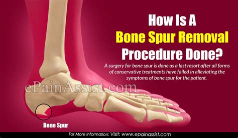 Can children get bone spur on top of both of their feet? How Is A Bone Spur Removal Procedure Done?