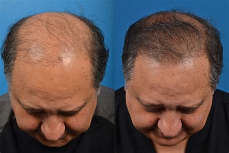 Hair Restoration Photos Melbourne Fl Patient