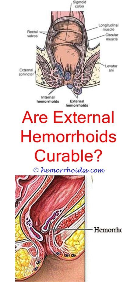 Thrombosed External Hemorrhoid Pictures