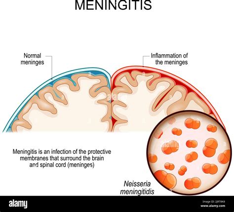 Bacteria Meningitis Imágenes Vectoriales De Stock Alamy
