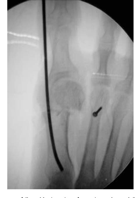 Figure 2 From Use Of Minimally Invasive Distal Metatarsal Osteotomy For