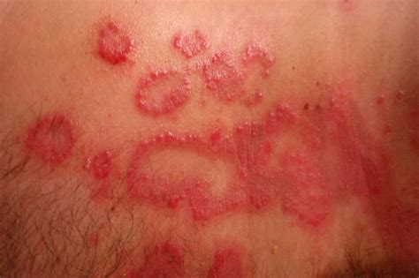 A Guide To Understanding Psoriasis