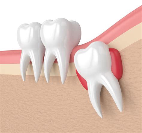 Common Signs You Need To Get Wisdom Teeth Removed Blog