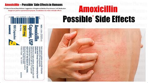 Amoxicillin Possible Side Effect Of Amoxicillin Amoxicillin