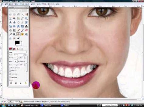 Feb 10, 2017 · how to remove dental glue yourself mix a paste from 2 teaspoons of baking soda and 1/2 teaspoon of peroxide. How to remove braces using GIMP 2.6 - YouTube