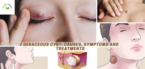 Sebaceous Cysts Causes Symptoms And Treatments