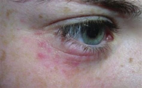 Rash Around Eyes Pictures And Natural Home Remedies 2019 Updated