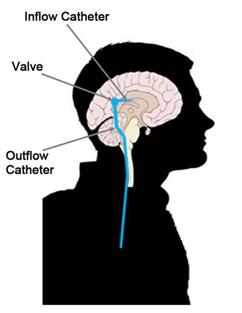 Cerebral Spinal Fluid Csf Shunt Systems Spinal Fluid Brain Diagram
