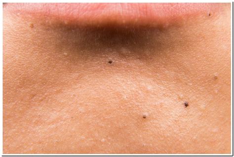 Tiny Black Dots On Skin Best Reviews