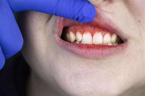 5 Natural Remedies For Swollen Gums That Actually Work Healthtipsghcom