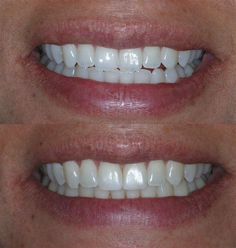 10 before and after photos you will love. Before & After Invisalign - Cosmetic Dentists of Houston ...