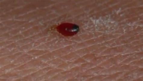 Do Baby Bed Bugs Bite Yes Heres Why
