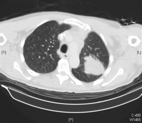 Pulmonary Adenocarcinoma Left Lung Ct Scan Case 239 Flickr