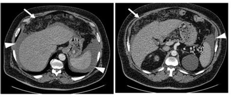 No Contrast Enhanced Ct Scan That Shows Peritoneal Fat Reticulation And