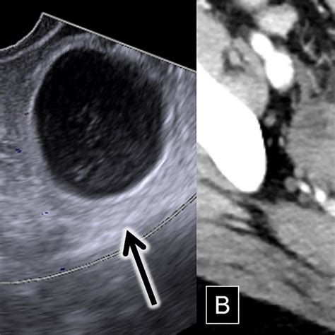 Year Old Female With Ovarian Torsion And A Corpus Luteum Cyst A