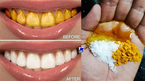 How To Whiten Your Yellow Teeth Naturally At Home In Just 23 Minutes
