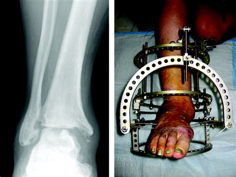 Foot And Ankle Surgery Considerations For The Geriatric Patient