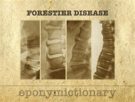 Forestier Disease LITFL Medical Eponym Library