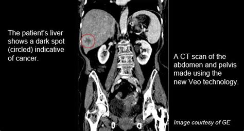 Black Spots On Ct Scan Of Abdomen And Pelvis Captions More