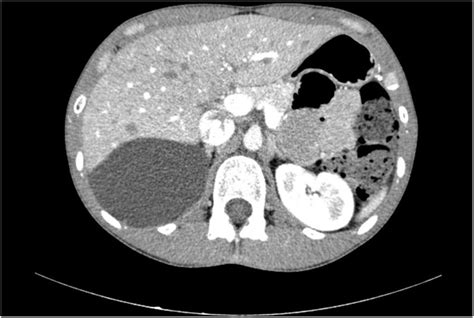Abdominal CT Scan A Septated Cystic Tumor Of Cm With Apparent No