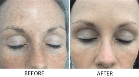 Ipl Photo Facial Bismarck Nd Pure Skin Aesthetic And Laser Center