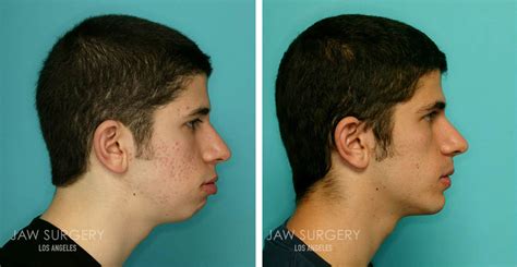 Jawline Surgery Men Before And After