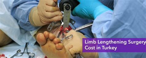 Limb Lengthening Surgery Cost In Turkey Limb Lengthening Turkey