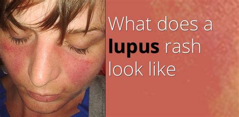 one of the most common signs of the condition known as lupus is also one of the most distinctive