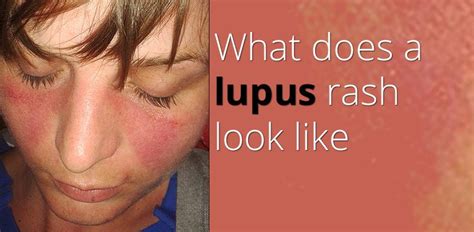 One Of The Most Common Signs Of The Condition Known As Lupus Is Also One Of The Most Distinctive