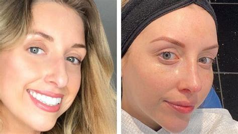 The patient should not only question, how much is good rhinoplasty? but. Non Surgical Nose Job - Everything You Need to Know - I ...