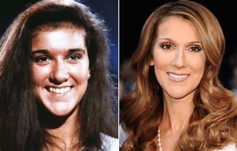 20 Celebrities Who Have Undergone Plastic Surgery