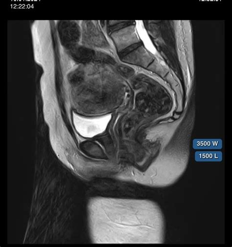 Advice Needed On What Recovery Tools I Would Need While Healing From A Myomectomy Possibly A