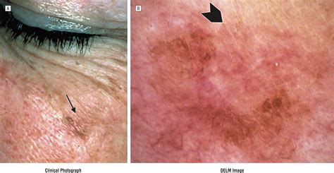 Use Of Digital Epiluminescence Microscopy To Help Define The Edge Of