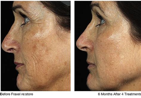 Fraxel Laser Treatment Laser Treatment For Face