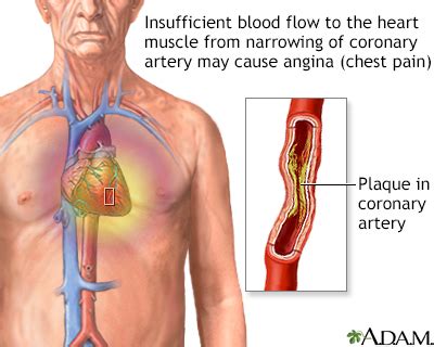 Stable Angina Information Mount Sinai New York