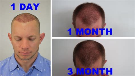 36 3 Month Hair Transplant Month By Month JasmanRaigan
