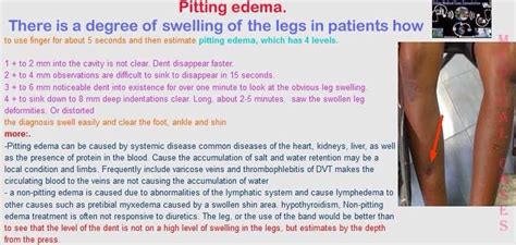 Pitting Edema Medfactscaution Some Images May Be